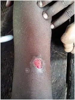 Ulcerated mother yaw