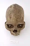A human skull showing signs of trepanning