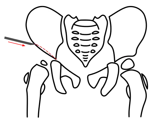 Acetabuloplasty, Step 1: Osteotomy of the ilium