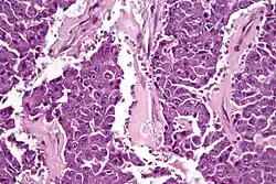 Pancreatic cancer cell in high magnification