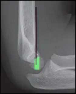 Anterior humeral line (black line), with normal area passed on the capitulum of the humerus colored in green in a 4-year-old child.[9]