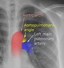 On a posteroanterior chest radiograph like this one, the left margin of the aortopulmonary space is normally seen as the "aortopulmonary angle".[1]