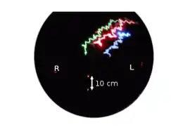 Unterberger test: Video documentation with image overlay