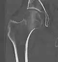 CT scan shows the same, atypical for a fracture since the cortex is coherent