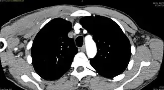 CT with IV contrast showing enlargement and heterogeneous hypodensity in the right pectoralis major muscle. A focal abscess collection with gas within it is present medially. There are enlarged axillary lymph nodes and some extension into the right hemithorax. Note the soft tissue and phlegmon surrounding the right internal mammary artery and vein. The patient was HIV+ and the pyomyositis is believed to be due to direct inoculation of the muscle related to parenteral drug abuse. The patient admitted to being a "pocket shooter"