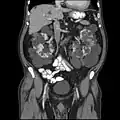 Abdominal CT scan of an adult with autosomal dominant polycystic kidney disease: Extensive cyst formation is seen over both kidneys, with a few cysts in the liver, as well. (Coronal plane)