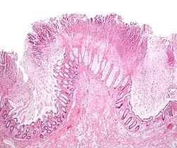 Micrograph of pseudomembranous colitis
