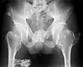 Multiple osteochondromas at the pelvis