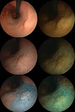 Endoscopic images of an early stage stomach cancer. 0-IIa, tub1. Left column: Normal light. Right column: computed image enhanced (FICE). First row: Normal. Second row: Acetate stained. Third row: Acetate-indigocarmine mixture (AIM) stained.