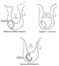 Different types of inguinal hernias.