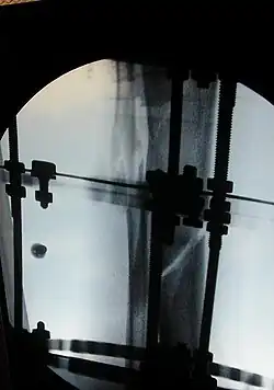 X-ray of the open fracture site immediately after installation of the Ilizarov apparatus.