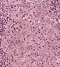 Undifferentiated nasopharyngeal carcinoma—high power