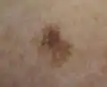 Melanoma in situ, left upper inner arm