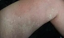 Multiple, hypopigmented macules and patches on the leg of an adult