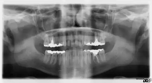 A panoramic radiograph of the mandibular region