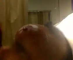 Picture demonstrating associated forehead swelling in patient with Pott’s puffy tumor.