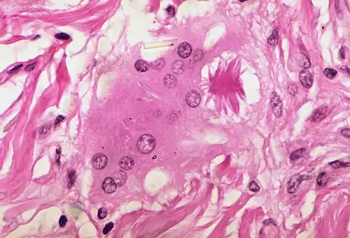 Asteroid body in sarcoidosis