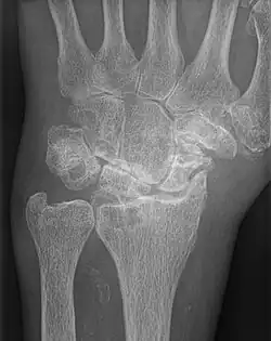 AP wrist x-ray demonstrating Stage III scapholunate advanced collapse