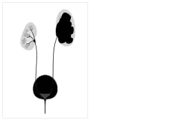 Pelvi-ureteric junction obstruction - easily mistaken for cystic renal disease on early scans
