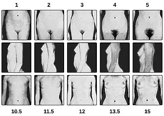 The five stages of pubic hair and breast growth, on a female subject