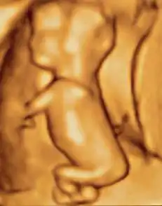 3D ultrasound of 75-millimetre (3.0 in) fetus (about 14 weeks gestational age)